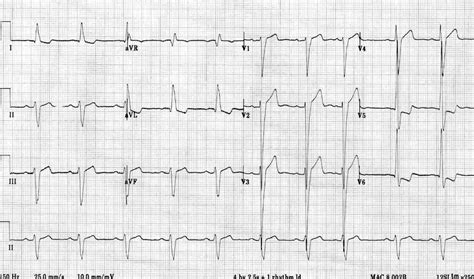 lv kt fb linergy|Left ventricular hypertrophy: Clinical findings and ECG diagnosis.